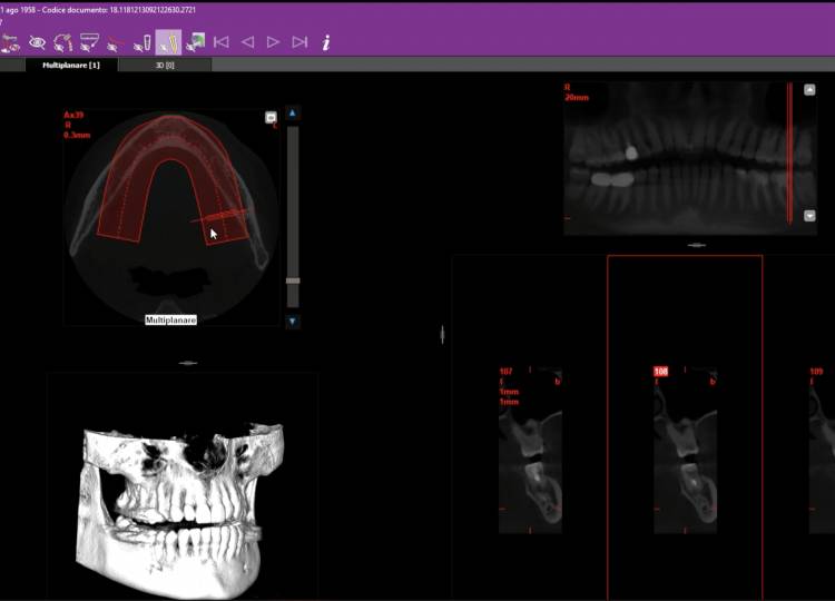CBCT Tomografia computerizzata cone beam