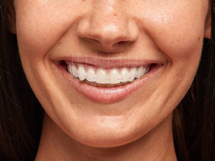 Digital smile design